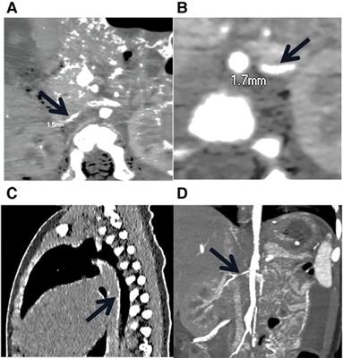 Case report: A rare homozygous variation in the ENPP1 gene, presenting with generalized arterial calcification of infancy in a Chinese infant